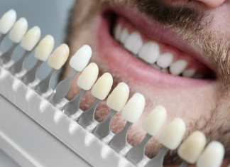 Ce trebuie să știi despre fațetele dentare