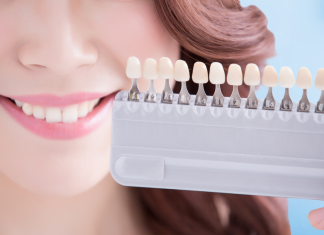 Albirea dentară – descoperă beneficiile acestui tratament care asigură un zâmbet perfect